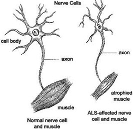 Motor neuron disease causes